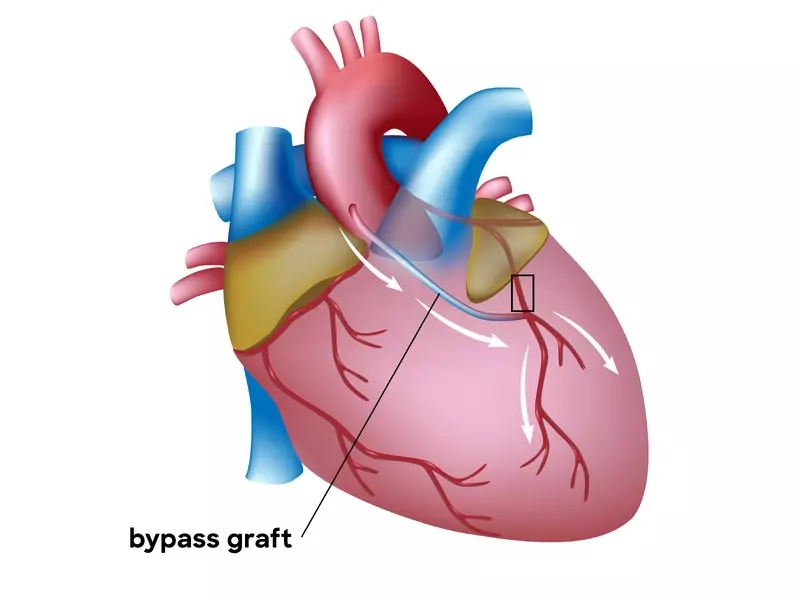 Illustration depicting Coronary Artery Bypass Grafting (CABG) procedure
