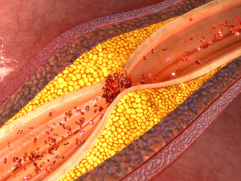 visual of an artery with coronary artery disease