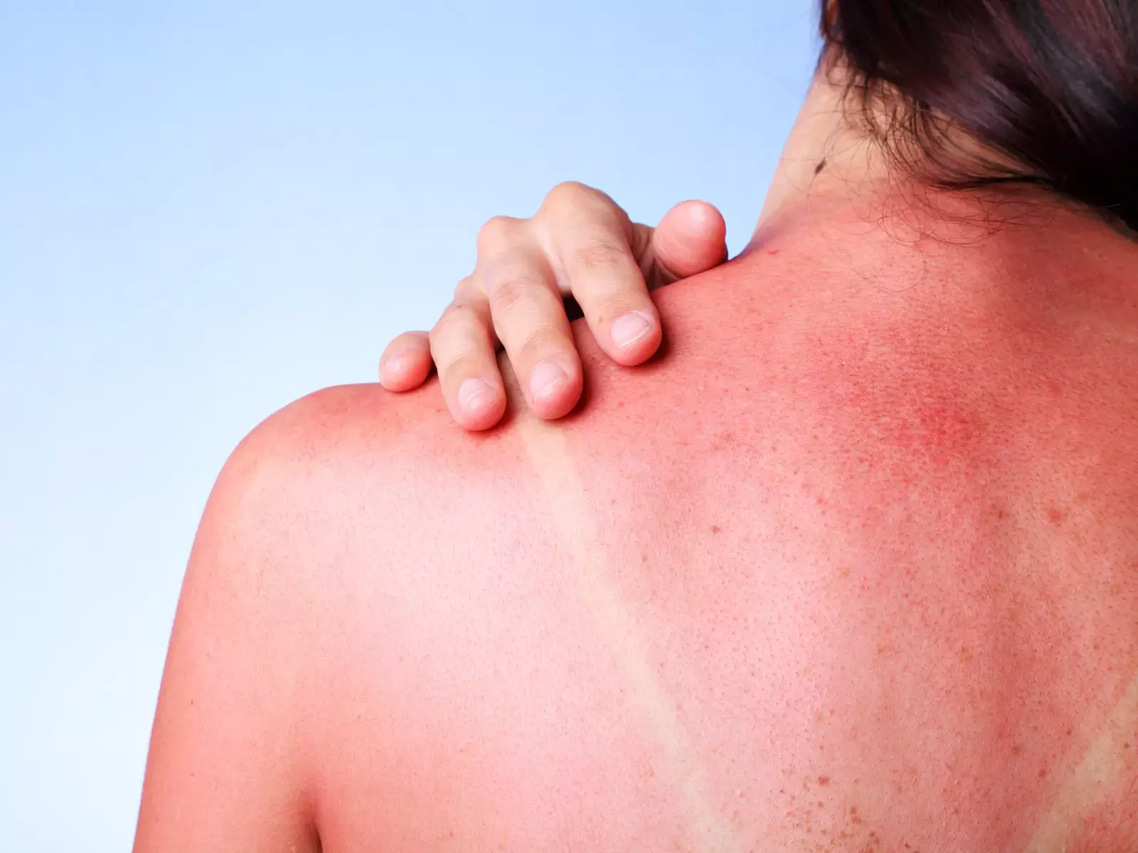Effective Home Remedies for Sunburn to Try