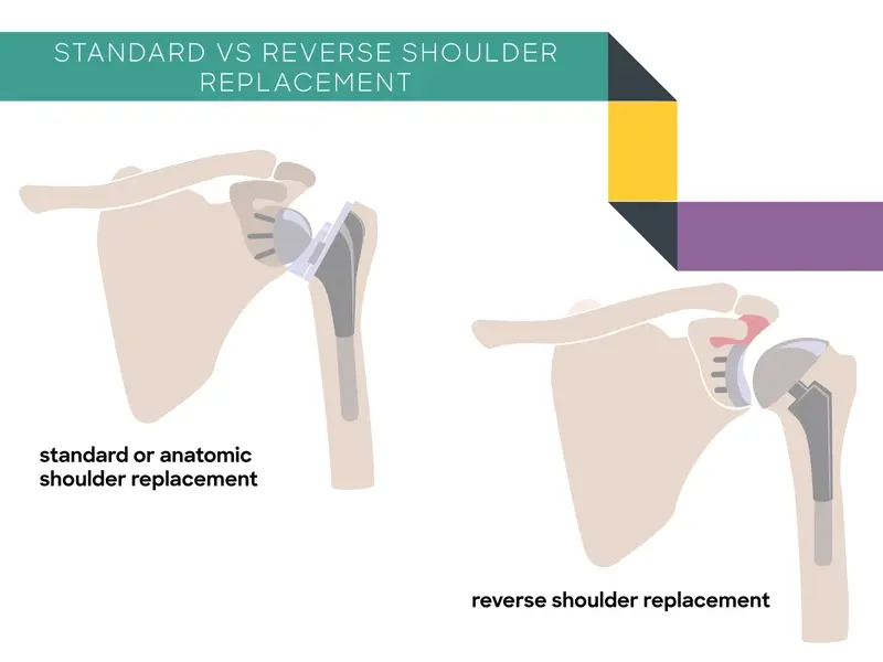 standard vs reverse shoulder replacement