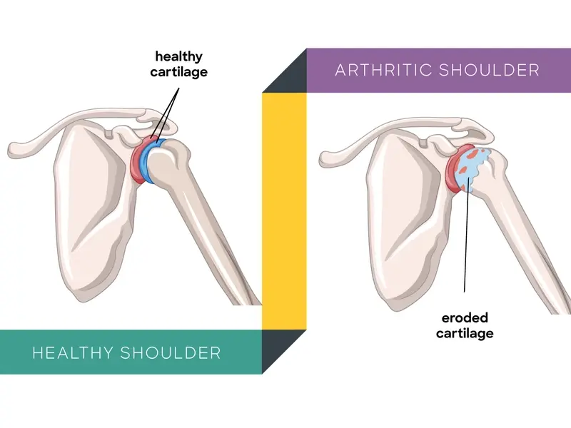 healthy shoulder vs arthritic shoulder