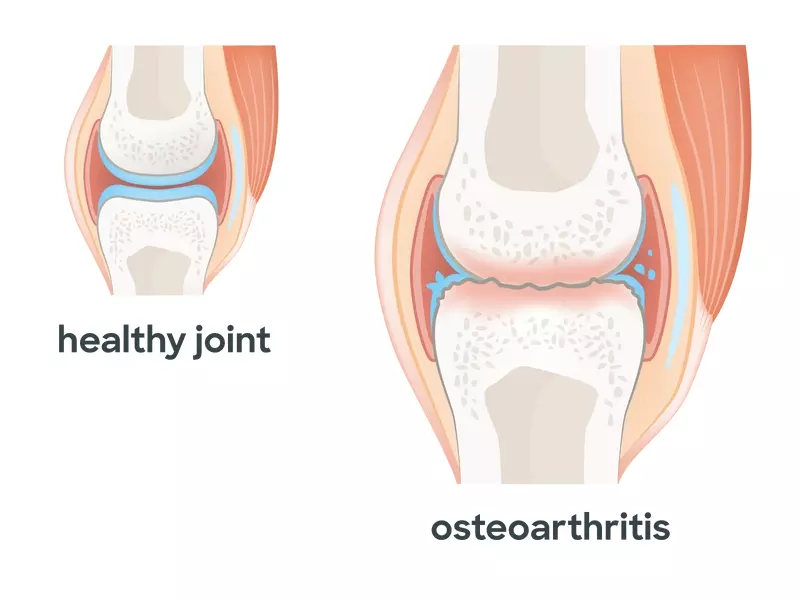 healthy joint vs joint with osteoarthritis illustration