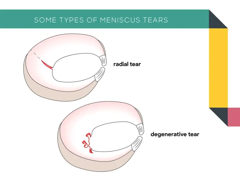 diagram of radial tears and degenerative tears