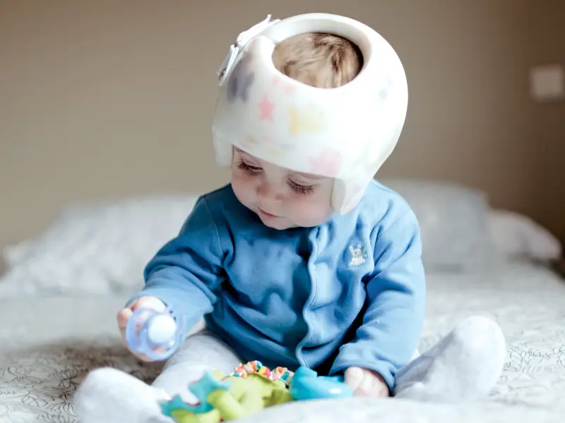 Baby wearing a helmet to treat plagiocephaly or flat head syndrome