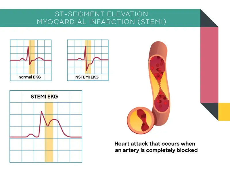 Illustration of an artey that is almost completely blocked of blood flow. STEMI heart attacks occur