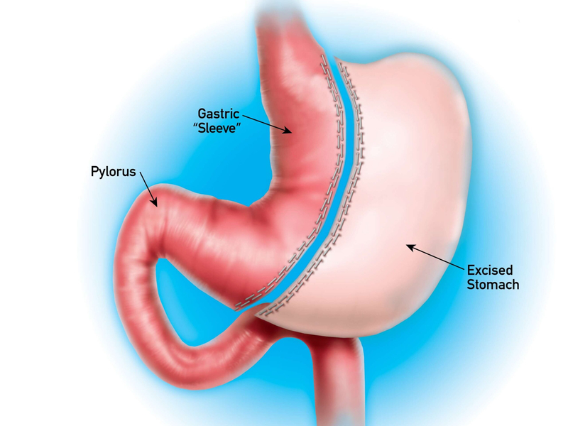 Gastric sleeve diagram