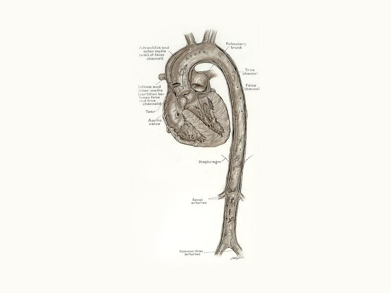 Diagram of dissection of entire aorta