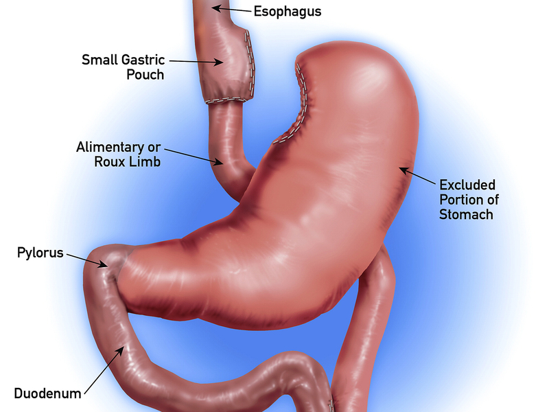 Gastric bypass diagram