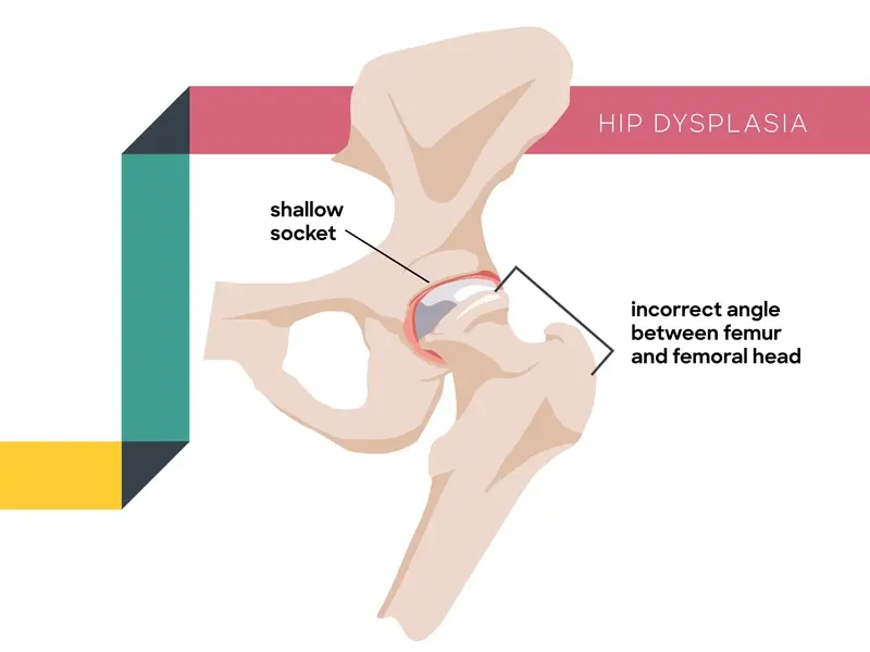 Hip dysplasia illustration