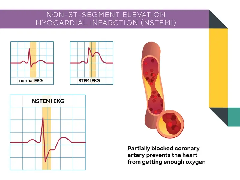 Illustration of an artey that is patrially blocked of blood flow. NSTEMI heart attacks occur when a