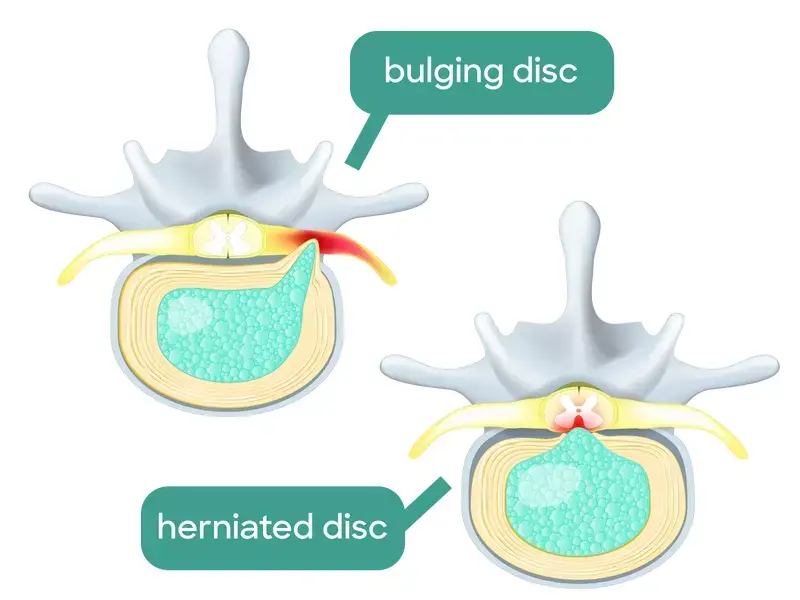 bulging disc vs herniated disc illustration