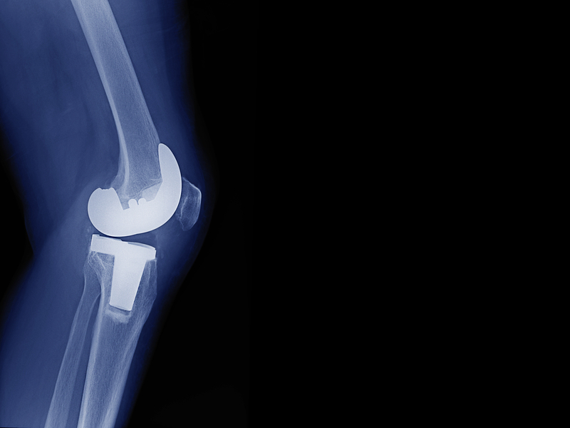 X-ray image of a total knee replacement