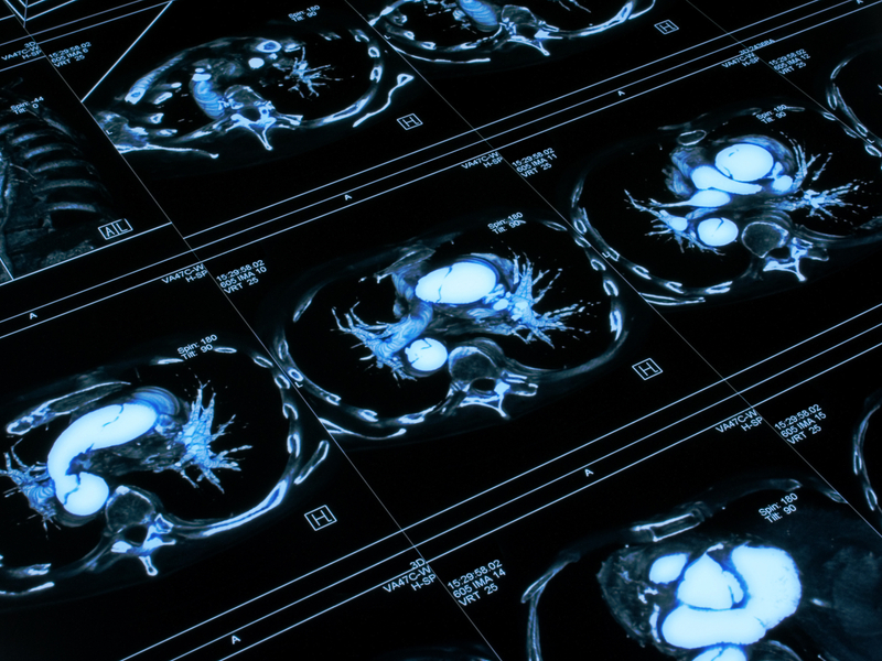 Heart CT scan